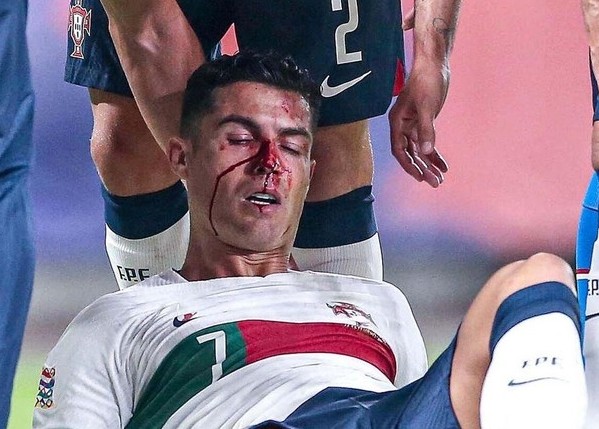 Ronaldo bê bết máu vì bị thủ môn đối phương đấm gãy mũi